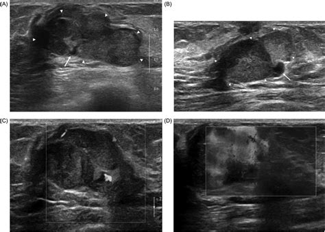 Transverse And Longitudinal Views Of Gray Scale Ultrasound Show A Download Scientific Diagram