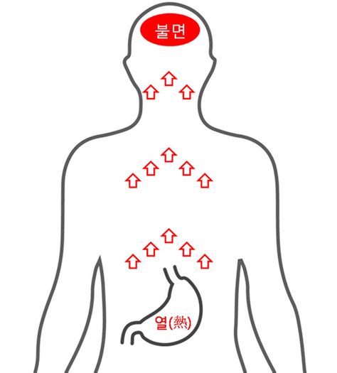 아이플러스 후기와 건강정보 불면증의 한방치료