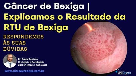 Bexiga Entendendo O Resultado Da Raspagem Para O Diagn Stico Do