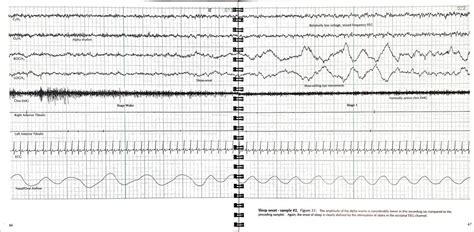 Diagnose | SleepEasy Centre