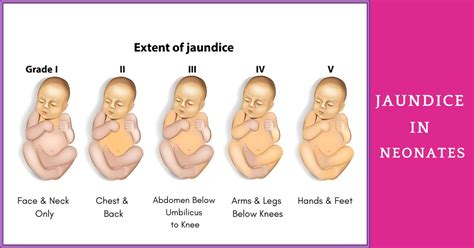 Why are newborns prone to jaundice? | Sri Ramakrishna Hospital