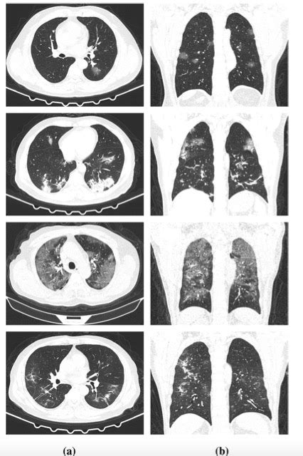 European Radiology动态三维放射组学分析在COVID 19分期中的应用 MedSci cn