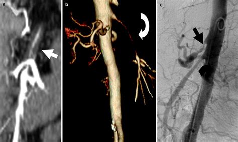 Mesenteric Vasculitis Thoracic Key