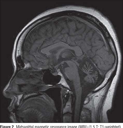 Figure 2 From Mapping Of Autosomal Dominant Cerebellar Ataxia Without