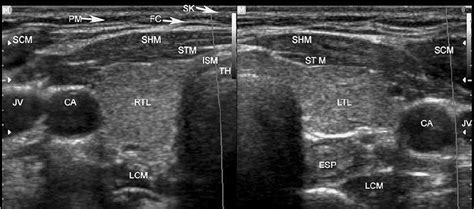 Neck Ultrasound Anatomy