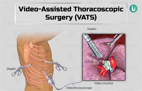 Video Assisted Thoracoscopic Surgery VATS Procedure Purpose