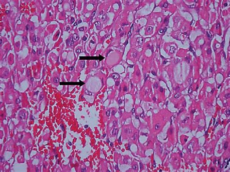 Microscopy Demonstrating Typical Signet Ring Cells Black Arrows With