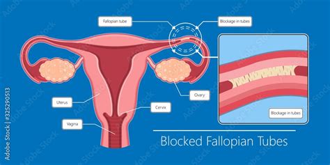 Hysterosalpingogram Hsg Test Blocked Fallopian Tubes Diagnose Tubal