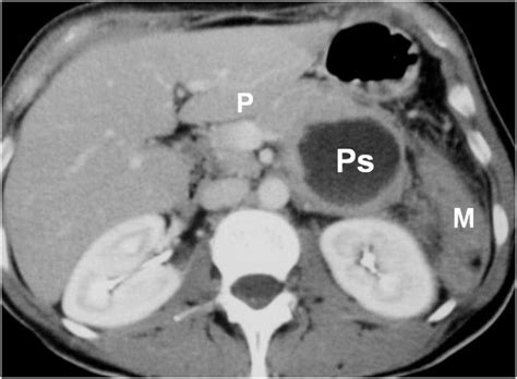 Carcinoma Pseudopapillare Solido Del Pancreas