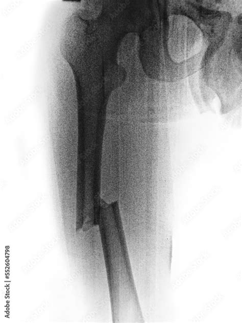 X-ray femur show complete fracture shaft of femur Stock Photo | Adobe Stock