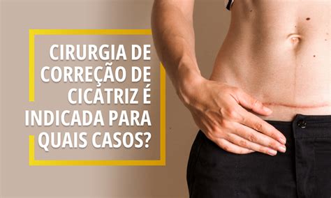 Cirurgia De Corre O De Cicatriz Indicada Para Quais Casos