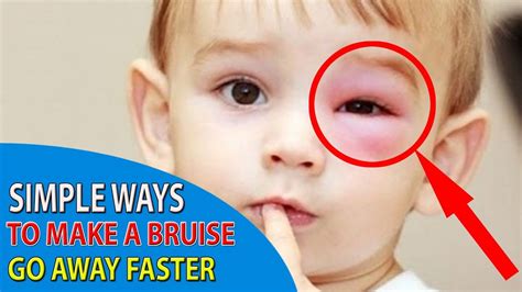 Effective And Simple Ways to Make a Bruise Go Away Faster - YouTube