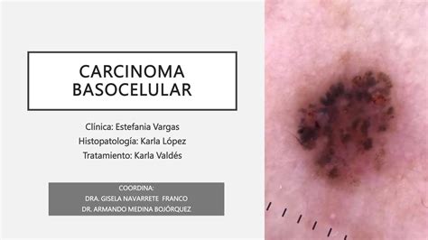 Carcinoma Basocelular Espinocelular Y Su Tratamiento Ppt