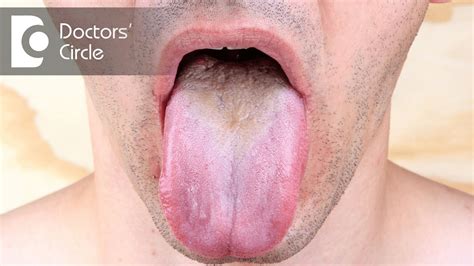 Diagnosis And Management Of Tongue Lesions Dr Jayaprakash Ittigi Youtube