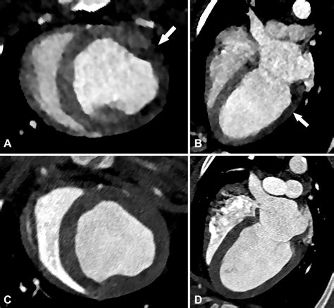 Ischemic Heart Disease Noninvasive Imaging Techniques And Findings