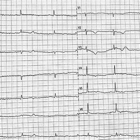 Electrocardiogram On Admission Showing Sinus Bradycardia With T Wave