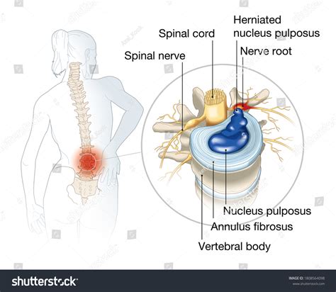 Illustration Showing Lumbal Vertebra Intervertebral Disc Stock