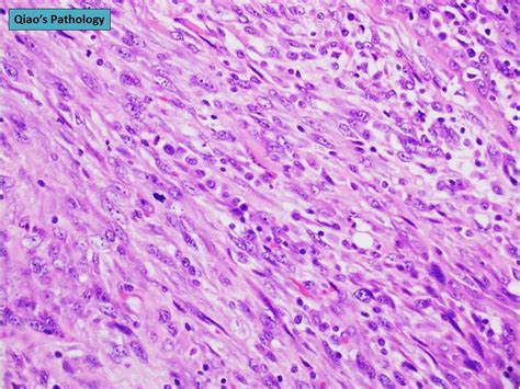 Qiao S Pathology Malignant Phyllodes Tumor Of The Breast A Photo On