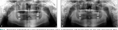 Figure 1 From A Comparative Study With Biphasic Calcium Phosphate To