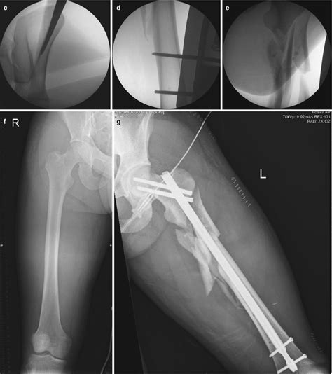 Subtrochanteric Fractures Musculoskeletal Key