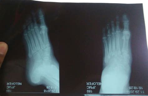 I had an accident four weeks back and injured my foot | Ask A Doctor Free | Best Answers ...