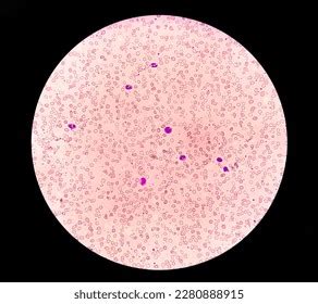 Blood Film Rbc Hypochromic Anisocytosis Microcytes Stock Photo 2280888915 | Shutterstock