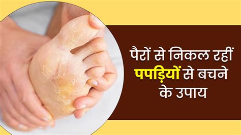 पैरों की स्किन से निकल रही हैं पपड़ियां इन 5 घरेलू उपाय से पाएं छुटकारा Home Remedies For