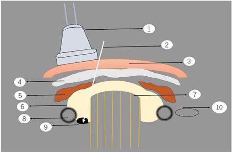 Schematic Diagram Of Ultrasound Guided Percutaneous Thermal Ablation Of