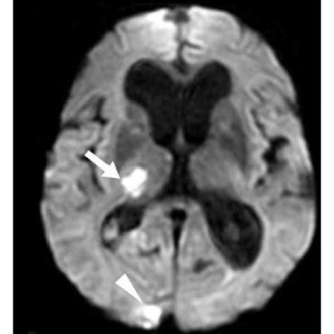 Pdf Thalamic Lesions A Radiological Review