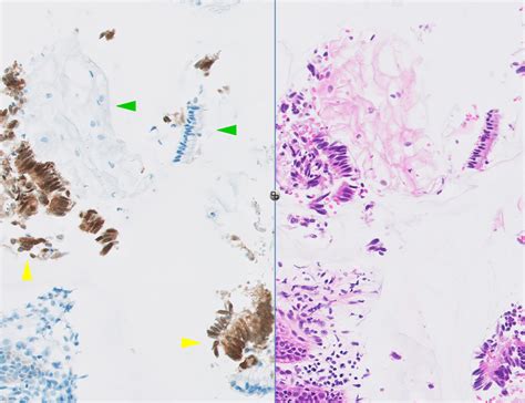 Pathology Outlines Adenocarcinoma In Situ