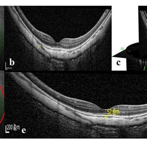 Stratified Analysis Of The Association Between Perforating Scleral Download Scientific Diagram