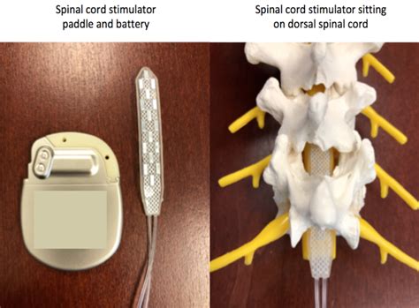 Spinal Cord Stimulation Rocky Mountain Brain And Spine Institute