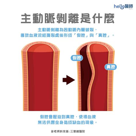 劇烈胸痛要小心！解析主動脈剝離原因、先兆及症狀，掌握4招有效預防