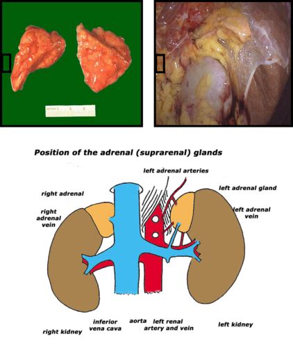 Adrenal Gland Gross Anatomy