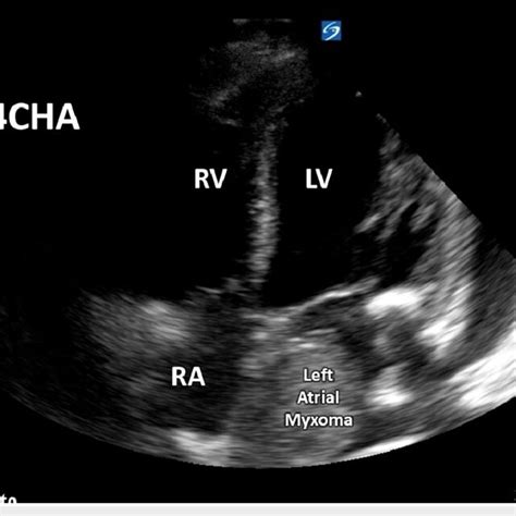 Transthoracic Echocardiogram Tte Left Atrial Myxoma Chamber View