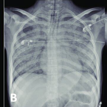 Chest Radiography Chest Radiography Of A The First Patient Showing