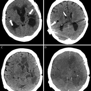 A: An axial CT scan on admission showed hydrocephalus and... | Download ...