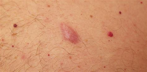 Common lumps and bumps on and under the skin: what are they?