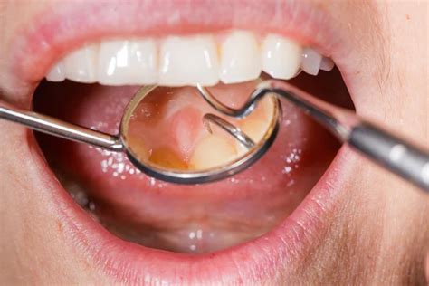 How To Cure Gum Disease Without A Dentist 10 Easy Ways