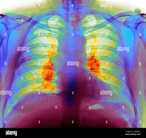 Sarcoidosis. Coloured frontal chest X-ray of the lungs of a 54-year-old ...