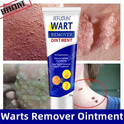 Warts Remover Cream Foot Corns Remover Cream Warts Removal Ointment To ...