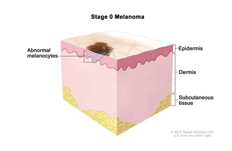 Tyrolean Lodge: Stage 0 Melanoma