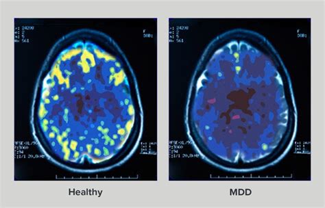 Brain Scan Depression