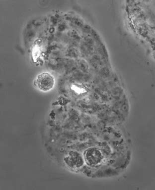 A renal tubular epithelial cell containing cast. Please note the renal ...