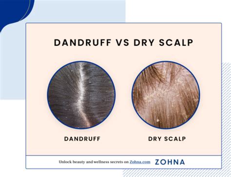 Dandruff vs Dry Scalp 2024 Guide: Differences, Causes & Solutions