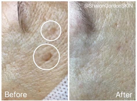 Seborrheic Keratosis — Sharon Gordon SKIN