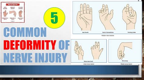 Deformity Of Nerve Injury Claw Hand Wrist Drop Foot Drop Ape Hand