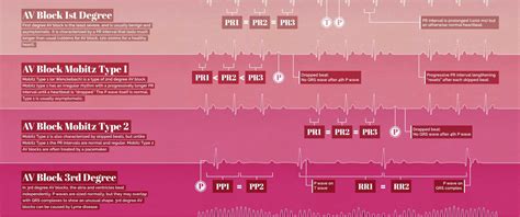 Abnormal heartbeat EKG waves