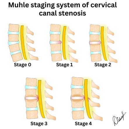 Cervical Spinal Stenosis - Amara Pain & Spine Management