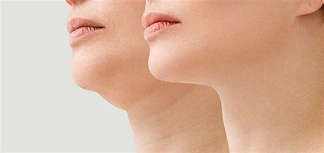 Double Chin Removal Non Surgical Syra Aesthetics